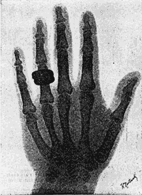 zdjcie rentgenowskie wykonane przez Roentgena